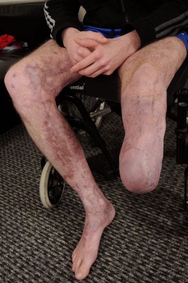 Man lost leg after “pals set him on fire as he slept drunk on bathroom floor”